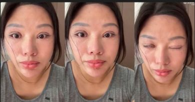 Hidup dengan Mata Tak Bisa Tertutup: Kisah Wang Li Usai Operasi Gagal